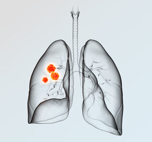 TROPION-Lung01: OS-Vorteil für Dato-DXd vs. Docetaxel beim nicht-plattenepithelialen NSCLC