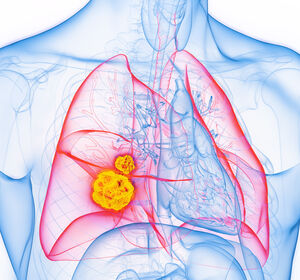 ESMO 2024: Zusammenhang der ctDNA-Clearance mit pCR und EFS beim R-NSCLC