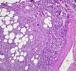 ESMO 2024: Subgruppenanalysen der AVENANCE-Studie zeigen langfristiges Überleben mit Avelumab bei aUC