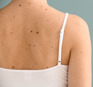 Kutanes Lymphom – Das Chamäleon der Dermatologie