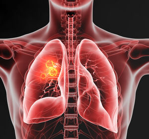 EGFR-mutierte NSCLC – Amivantamab/Lazertinib mit Überlebensvorteilen