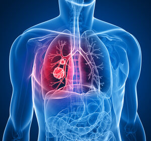 HERTHENA-Lung02: PFS-Verbesserung unter Patritumab deruxtecan beim EGFR-mutierten NSCLC