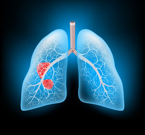 Fortgeschrittenes NSCLC mit EGFR-Mutation – Mit Amivantamab längeres progressionsfreies Überleben