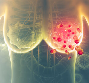 ER+/HER2- Mammakarzinom: Während oder nach einer endokrinen Therapie eine Kombinationstherapie mit Capivasertib erwägen