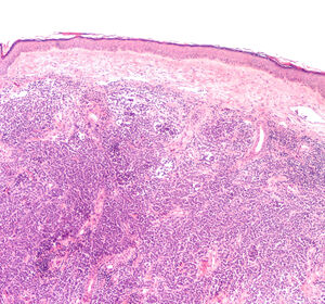 Update zu Avelumab beim metastasierten Merkelzellkarzinom