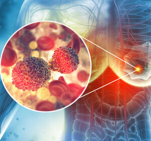 SABCS: Neue orale SERD-Therapie zeigt Potenzial in Kombination und als Monotherapie bei fortgeschrittenem Brustkrebs