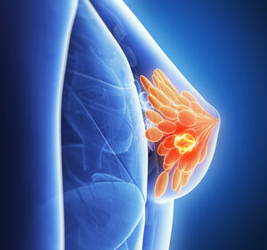 SABCS: Erste Daten der PADMA-Studie zu Palbociclib + ET beim HR+/HER2- Mammakarzinom