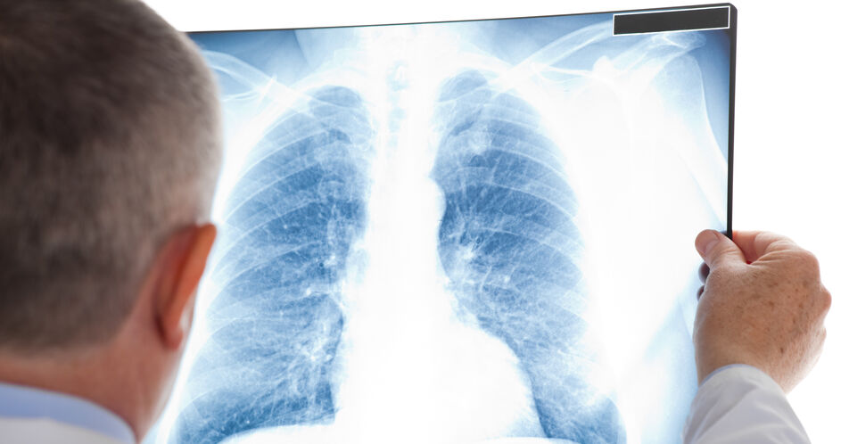 Lungenkrebs: Auch auf NTRK-Fusionen testen, weil TRK-Inhibitoren längerfristig nutzen