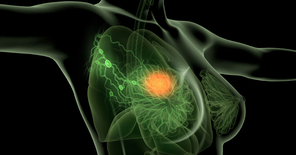 Adjuvantes Abemaciclib beim frühen HR+ Brustkrebs: ctDNA-Bestimmung zu Therapiebeginn und im Verlauf erlaubt prognostische Aussagen zu Outcomes