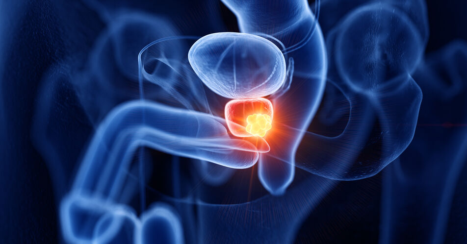 Prostatakarzinom: S3-Leitlinie zur häufigsten Krebserkrankung bei Männern aktualisiert