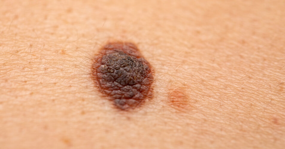 Nicht-invasive Echtzeit-Biopsie zur Hautkrebs-Früherkennung