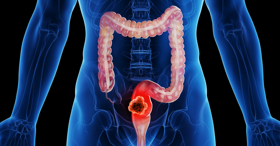 Entwicklungen in der Therapielandschaft des metastasierten Kolorektalkarzinoms: aktuelle Konzepte und neue Perspektiven