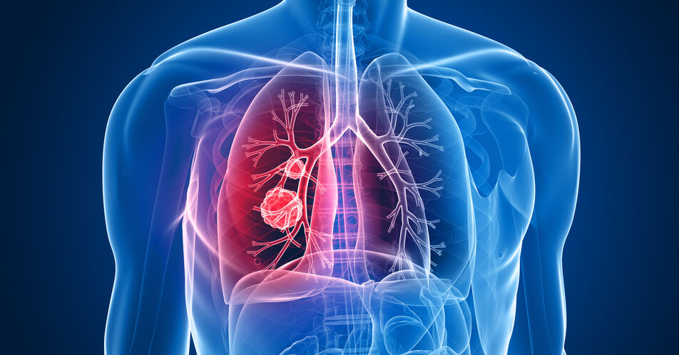 NSCLC: Neue Studie zu mRNA-4157 + Pembrolizumab – Rekrutierung in Deutschland beginnt