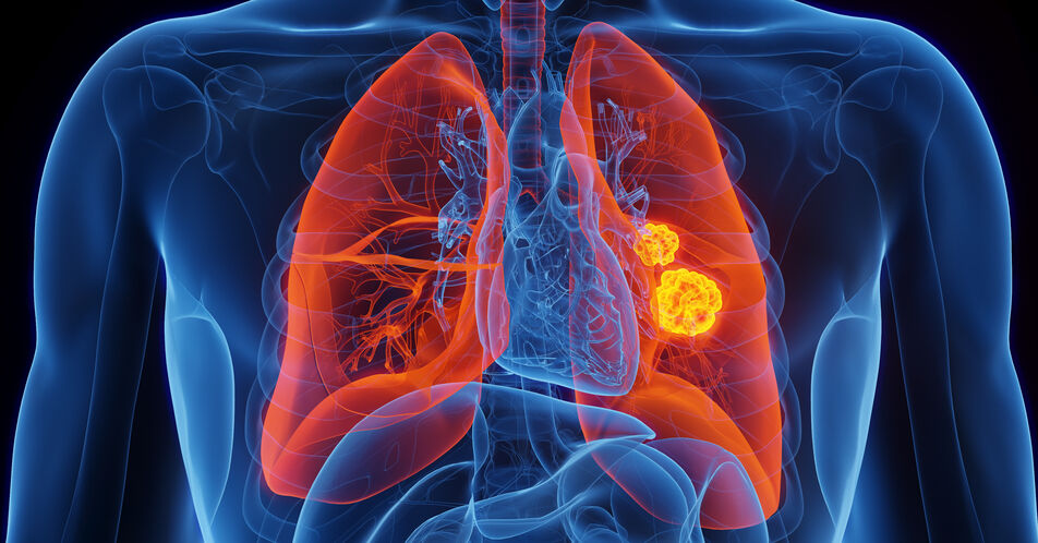 HER2-mutiertes NSCLC: Neue Daten zu BAY 2927088 aus der SOHO-01-Studie