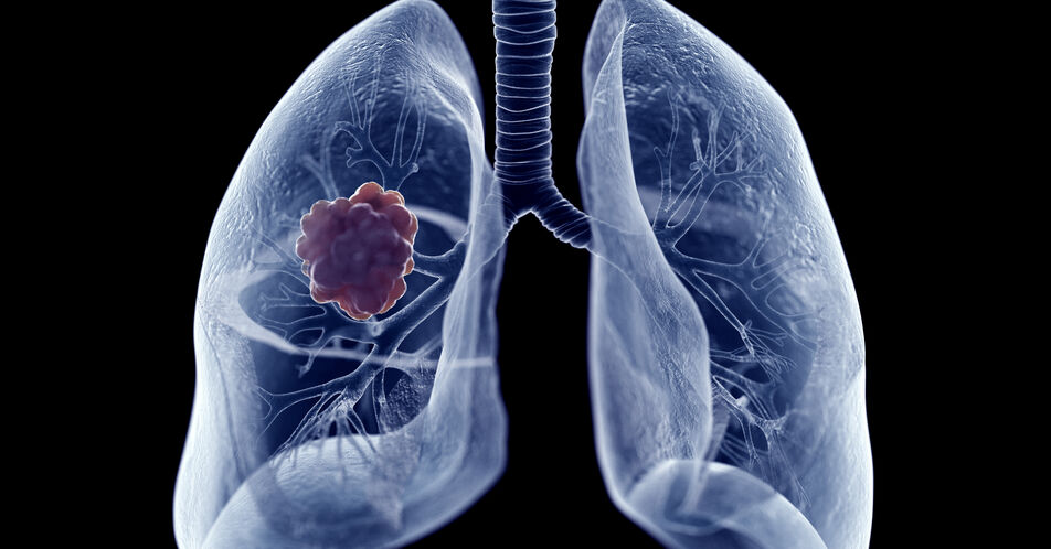 Fortgeschrittenes NSCLC mit EGFR-Mutation: Neue Langzeitdaten aus der MARIPOSA-Studie