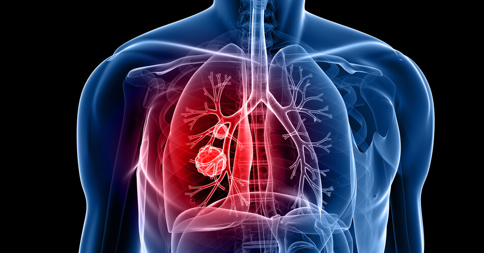 Erstlinientherapie des ALK+ NSCLC: 5-Jahres-Update der CROWN-Studie zu Lorlatinib