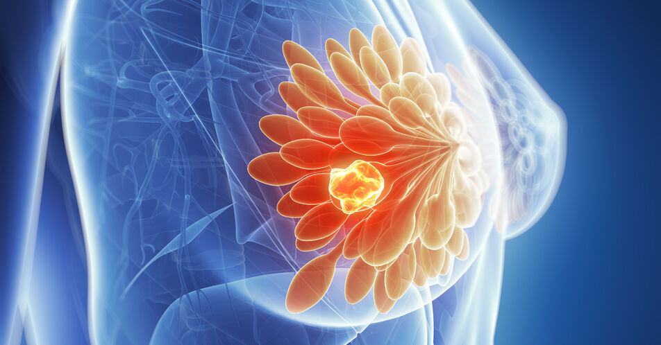 ESMO: Studie untersucht Wirkung und Resistenz unter T-DXd beim HER2+/HER2-low mBC