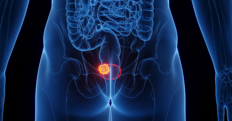  ESMO: Überlebensvorteil unter Enfortumab Vedotin + Pembrolizumab bei la/mUC unabhängig von der Nectin-4-Expression