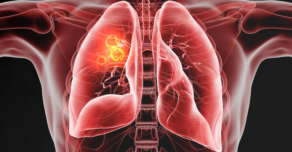 ESMO 2024: Wirksamkeit und Sicherheit von Belrestotug plus Dostarlimab bei Patient:innen mit PD-L1-hochgradigem LA/M-NSCLC