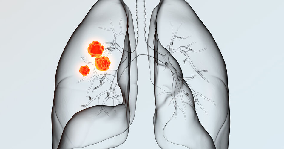 TROPION-Lung01: OS-Vorteil für Dato-DXd vs. Docetaxel beim nicht-plattenepithelialen NSCLC