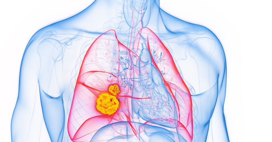 ESMO 2024: Zusammenhang der ctDNA-Clearance mit pCR und EFS beim R-NSCLC