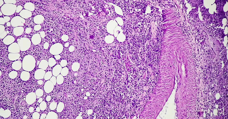 ESMO 2024: Subgruppenanalysen der AVENANCE-Studie zeigen langfristiges Überleben mit Avelumab bei aUC