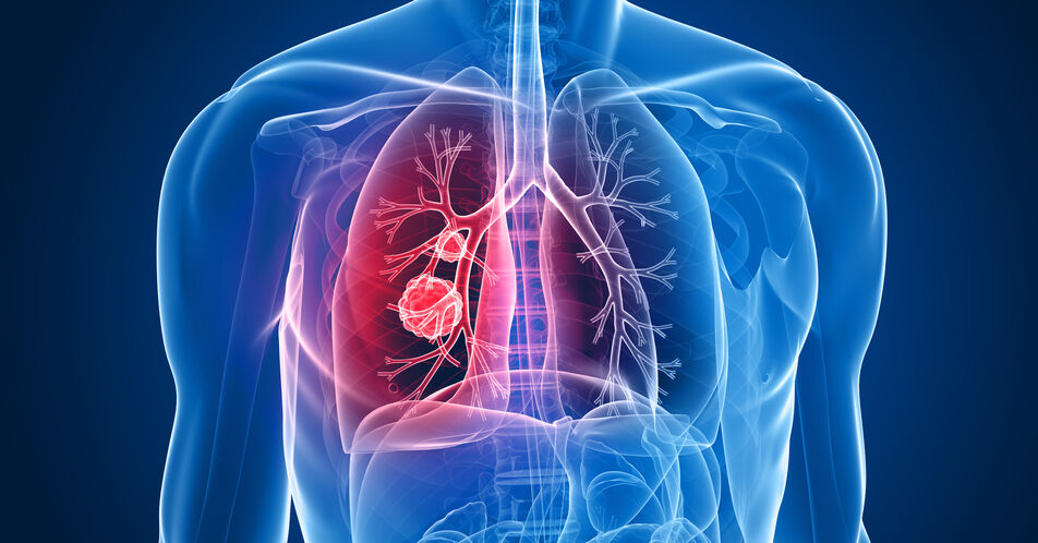 HERTHENA-Lung02: PFS-Verbesserung unter Patritumab deruxtecan beim EGFR-mutierten NSCLC