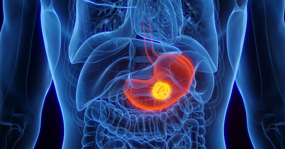 Zolbetuximab in der Therapie des Magenkarzinoms und die Bedeutung des Biomarkers Claudin 18.2