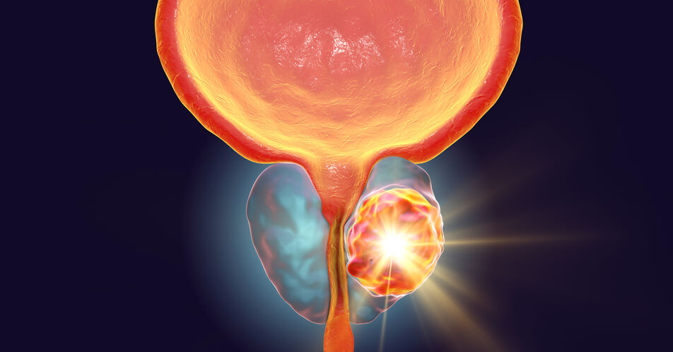 Update zur Anwendung von PARP-Inhibitoren beim mCRPC