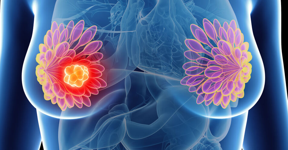 Zulassungsempfehlung für Ribociclib zur Behandlung des frühen HR+/HER2- Mammakarzinoms