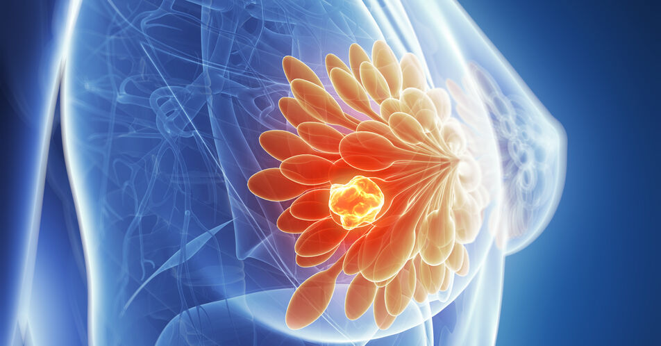 HR+/HER2- frühes Mammakarzinom: Neue Perspektiven mit Abemaciclib bei hohem Rezidivrisiko