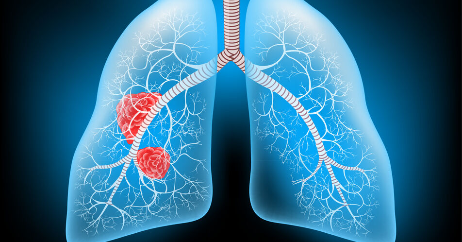 Fortgeschrittenes NSCLC mit EGFR-Mutation – Mit Amivantamab längeres progressionsfreies Überleben