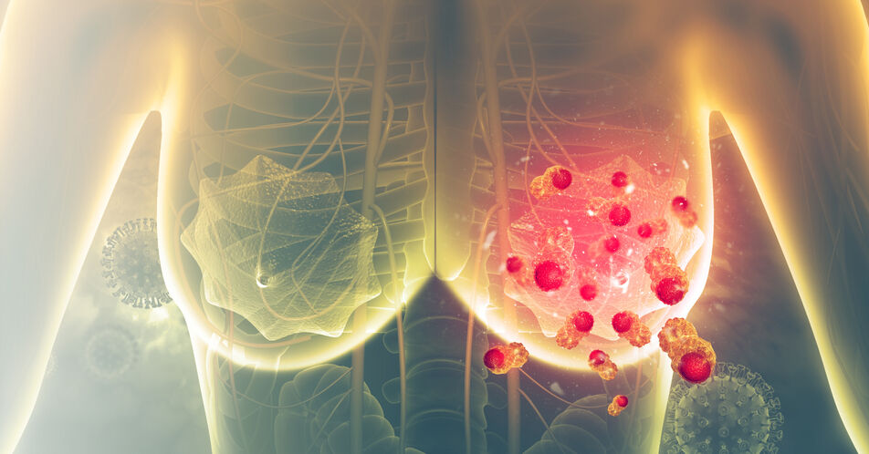 ER+/HER2- Mammakarzinom: Während oder nach einer endokrinen Therapie eine Kombinationstherapie mit Capivasertib erwägen