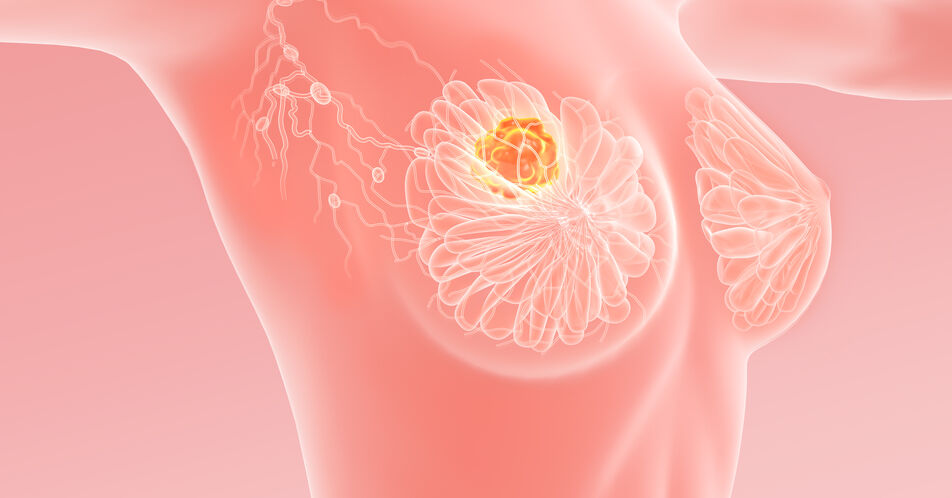 HR+/HER2- Mammakarzinom: Real-World-Daten bestätigen Wirksamkeit von Palbociclib auch bei Subgruppen