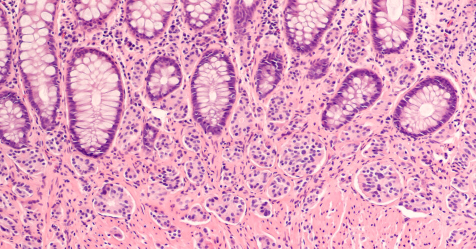 ESMO 2024: Ergebnisse der Phase-III-Studie CABINET bestätigen Wirksamkeit von Cabozantinib bei fortgeschrittenen NET 