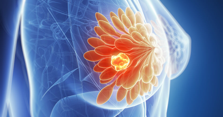 HR+ metastasiertes Mammakarzinom: Fortschritte mit Capivasertib in der Biomarker-basierten Zweitlinientherapie