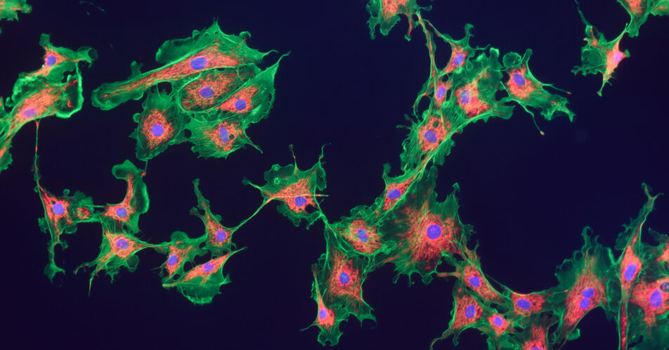 Studie identifiziert Subtypen von Fibroblasten bei Hautkrebs