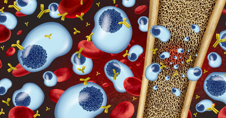 Multiples Myelom: Neue 4-fach Kombination in der Erstlinie zugelassen