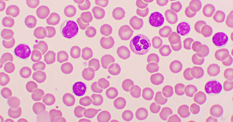 ASH: Zeitlich limitiertes Schema Acalabrutinib plus Venetoclax (± Obinutuzumab) verlängert PFS vs. FCR/BR bei therapienaiver CLL