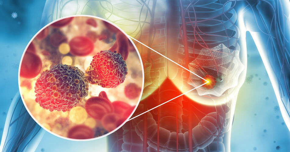 SABCS: Neue orale SERD-Therapie zeigt Potenzial in Kombination und als Monotherapie bei fortgeschrittenem Brustkrebs