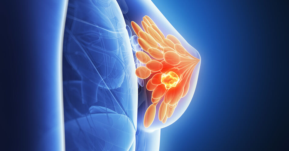 SABCS: Erste Daten der PADMA-Studie zu Palbociclib + ET beim HR+/HER2- Mammakarzinom