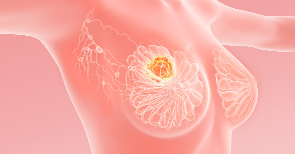 ADCs bei HR+/HER2- mBC: Innovative Therapie nach endokriner Resistenz und Vorbehandlung  