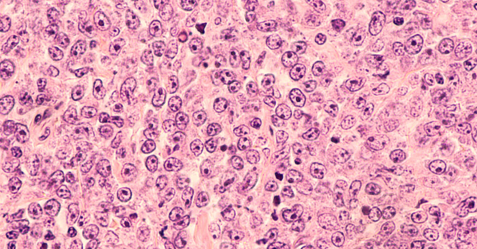 CAR-T-Zelltherapie: Neuer Therapiestandard bei früh r/r DLBCL