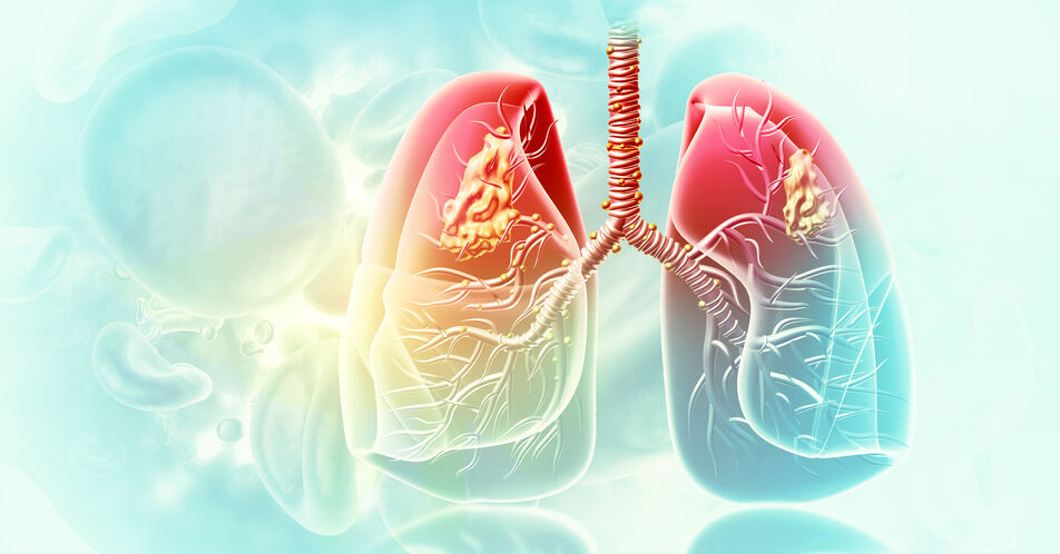 Amivantamab plus Lazertinib: EU-Zulassung für Erstlinientherapie bei EGFR-mutiertem NSCLC